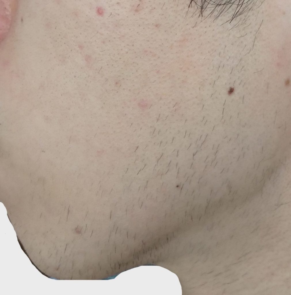 左もみあげ１２回目脱毛開始直前の剃毛１週間後